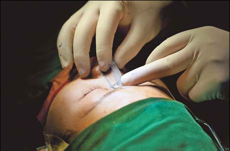 Inside China's mini-plastic surgery industry